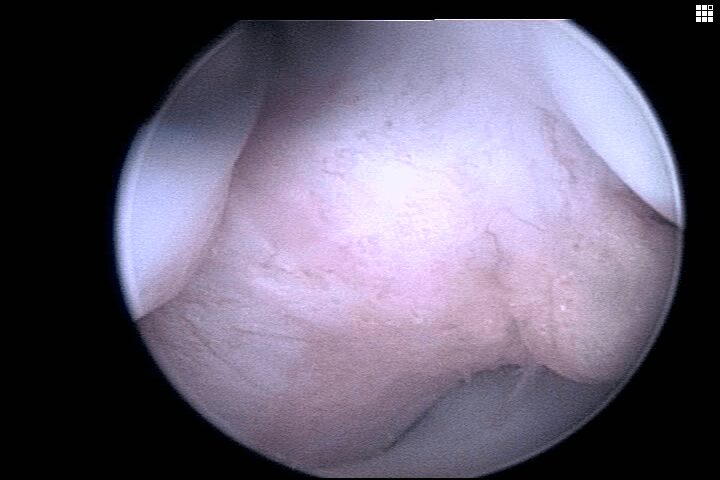 image of a shoulder bone taken with a scope