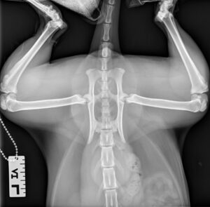 Spinal Trauma: Capital Physis Pathological Fracture